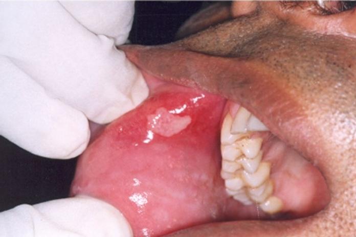 objawy zapalenia jamy ustnej