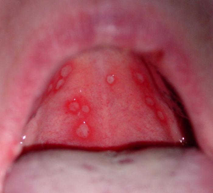 grzybicze zapalenie jamy ustnej