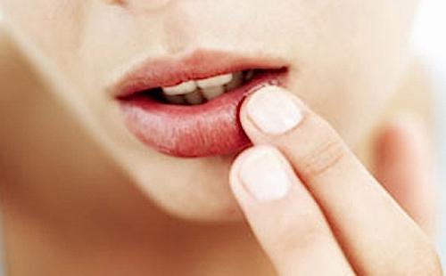 stomatitis u ustima
