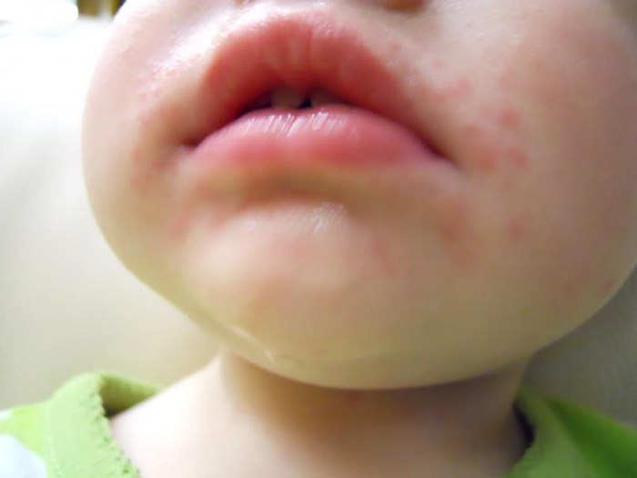 Алергия към ягоди при симптоми на детето