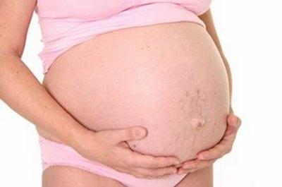 rozstępy w czasie ciąży