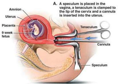 менструација након хируршког абортуса