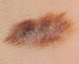 segni di melanoma