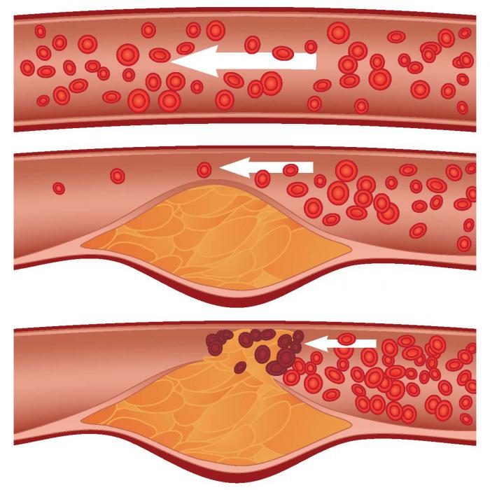 příznaky aterosklerózy
