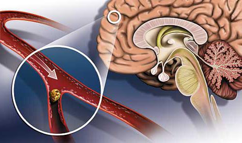 příznaky mozkové arteriosklerózy
