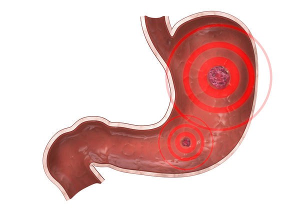 simptomi erozivnog gastritisa