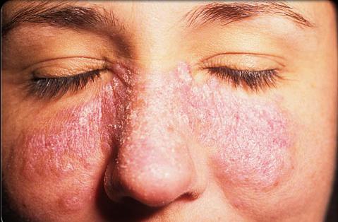 příznaky lupus erythematosus u žen