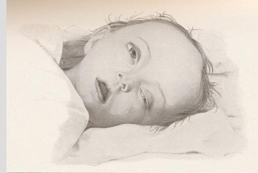 Sintomi di meningite in un bambino
