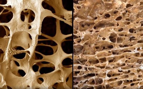 prevenzione dell'osteoporosi