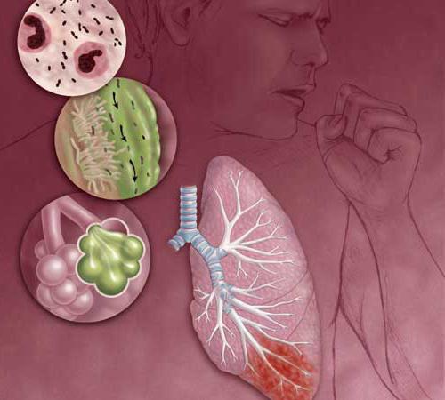 sintomi di polmonite in un adulto senza febbre