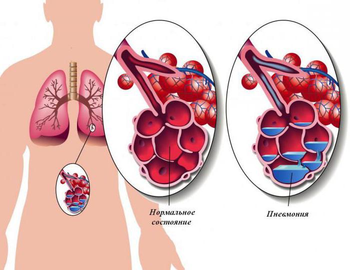 simptomi pljučnice pri odraslih brez zvišane telesne temperature