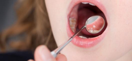 objawy zapalenia jamy ustnej u dziecka