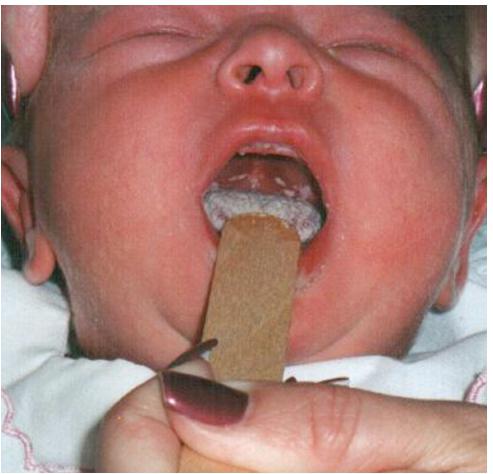 wirusowe zapalenie jamy ustnej u dzieci