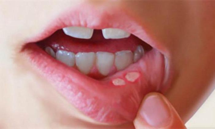 как да се разграничи студ на устните на сифилис