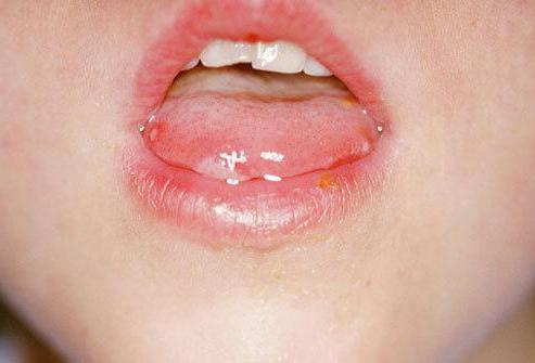 sifilide sulle labbra