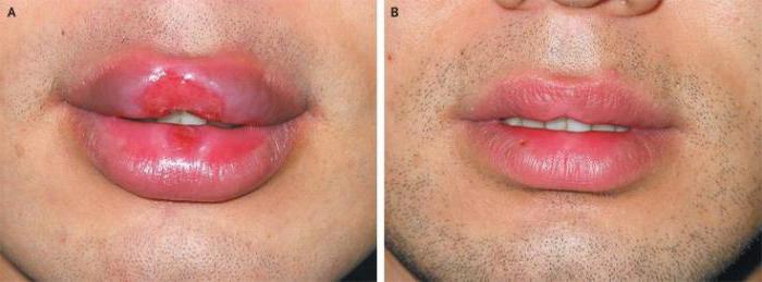 sifilis na ustnicah, ki jih preskušajo