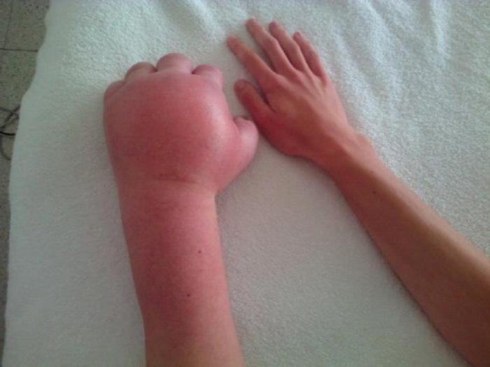Синдром на Зудек след фрактура на костите в ръката