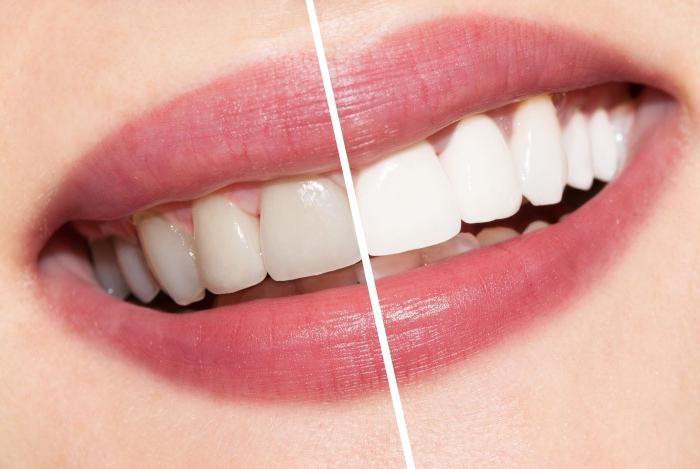 избјељивање зуби уље чајевца прегледава стоматологе
