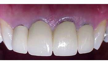металокерамични зъби