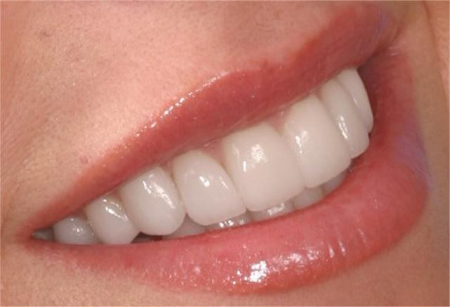stroški kovinsko-keramičnih zob