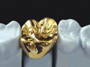 Керметните зъби