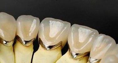 postavite kermet za zobe