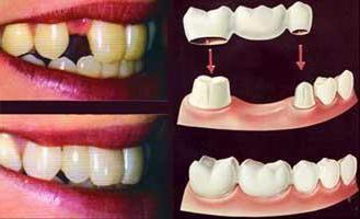 cermetové zuby před a po