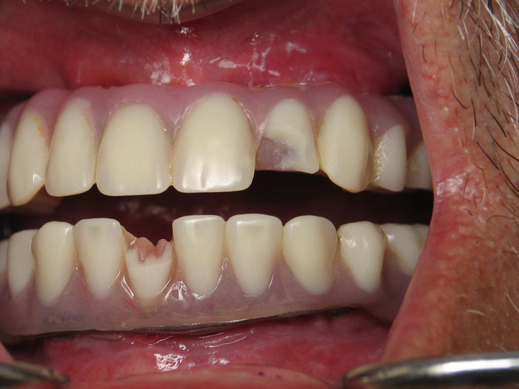 Lesioni ai denti