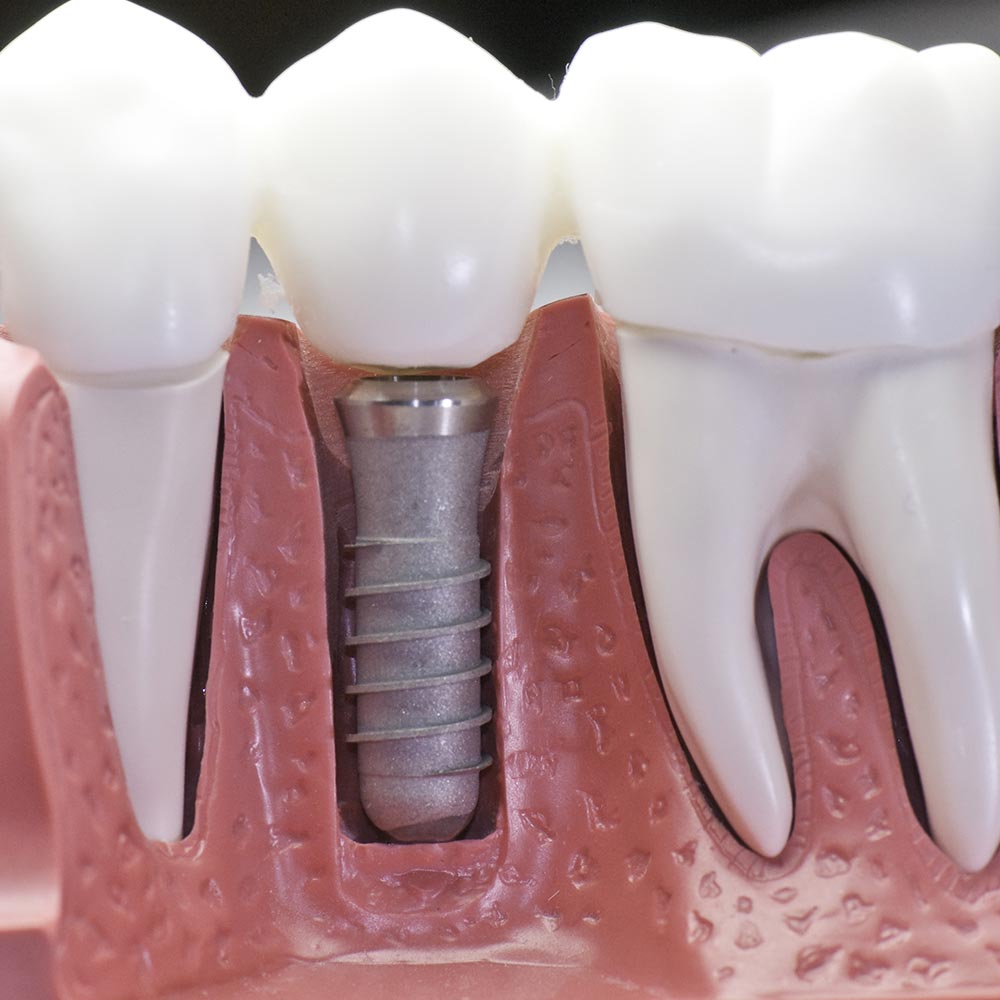 Metodi moderni di restauro dei denti
