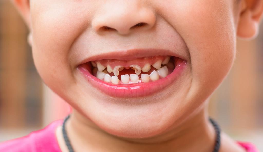 Obnova zubů u dětí