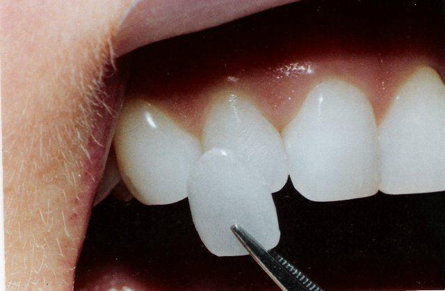 pregledi zobnih furnirjev