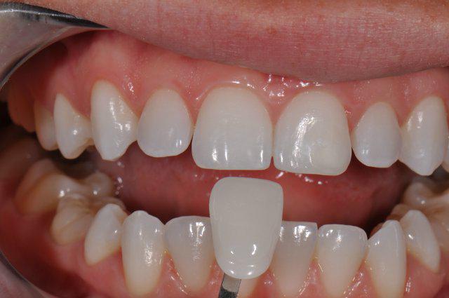 фасети в стоматологията
