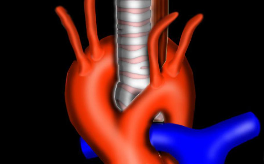 come appare l'aorta