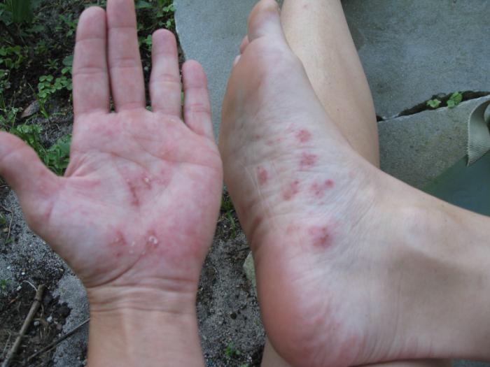 Cause di eczema sulle mani