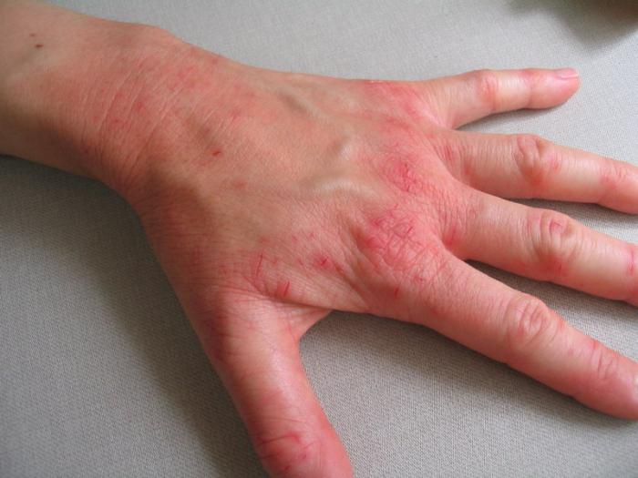 Eczema sulle cause delle mani