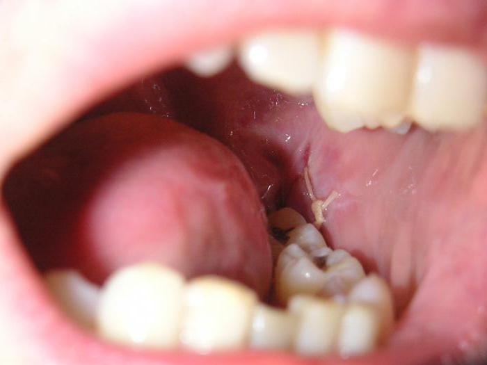 posledice ekstrakcije modrinega zoba