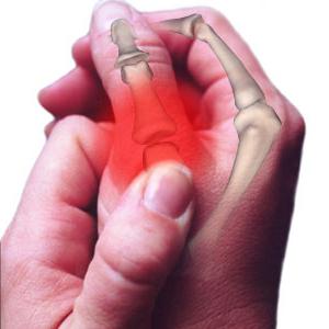 Artritis z mazilom indometacina
