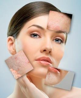 contro l'acne
