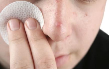 recensioni di anti metrogil acne