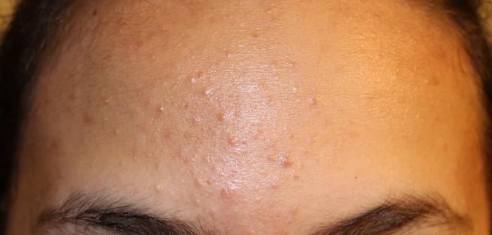 recensioni di gel di metrogil acne