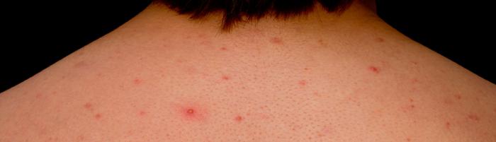 metrogil leđa acne recenzije