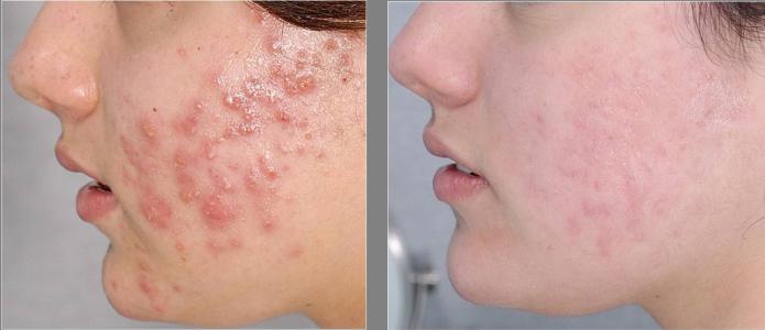 recensioni di acne metrogil Price