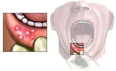 recensioni di paste adesive dentali solcoseryl