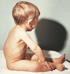 tuberkulózy u dětí mladších tří let