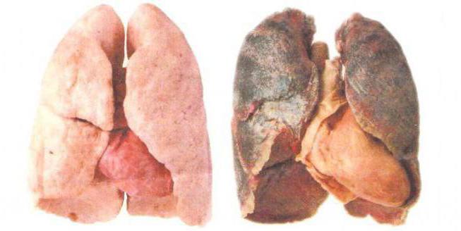 рентгенова снимка на белите дробове на пушач и здрав човек