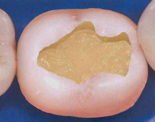struttura del dente nella sezione