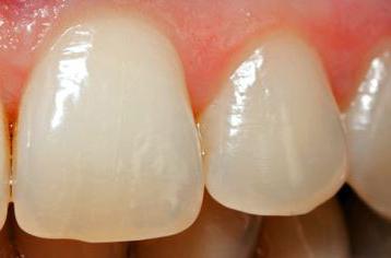 la struttura dei denti della mascella superiore di una persona