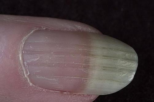 Struktura paznokcia i płytki paznokcia