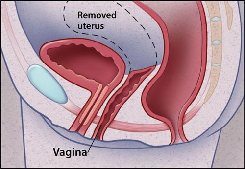 veličine uterusa žene