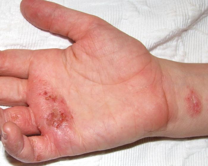 trattamento di eczema